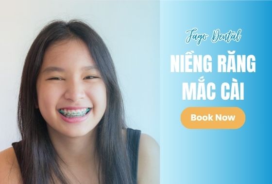 Niềng Răng Mắc Cài
