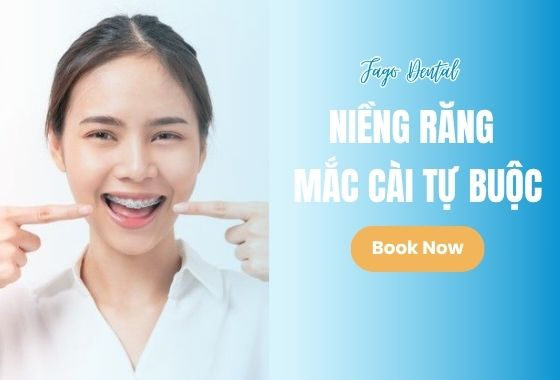 Niềng Răng Mắc Cài Tự Buộc 