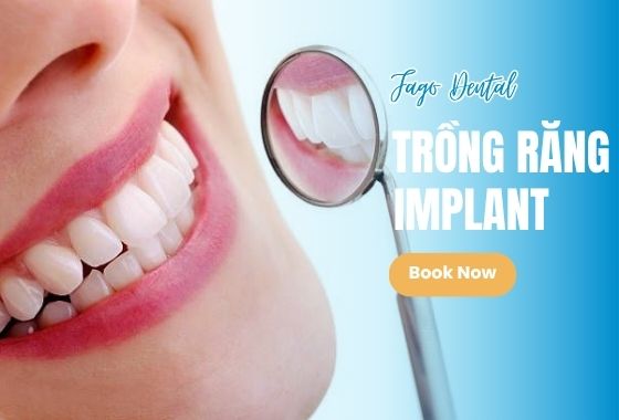 Trồng Răng Implant 