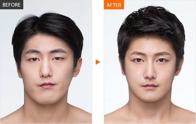 Mặt Lệch Bên Phải Thì Nhai Bên Nào? Cách Điều Trị Tốt Nhất